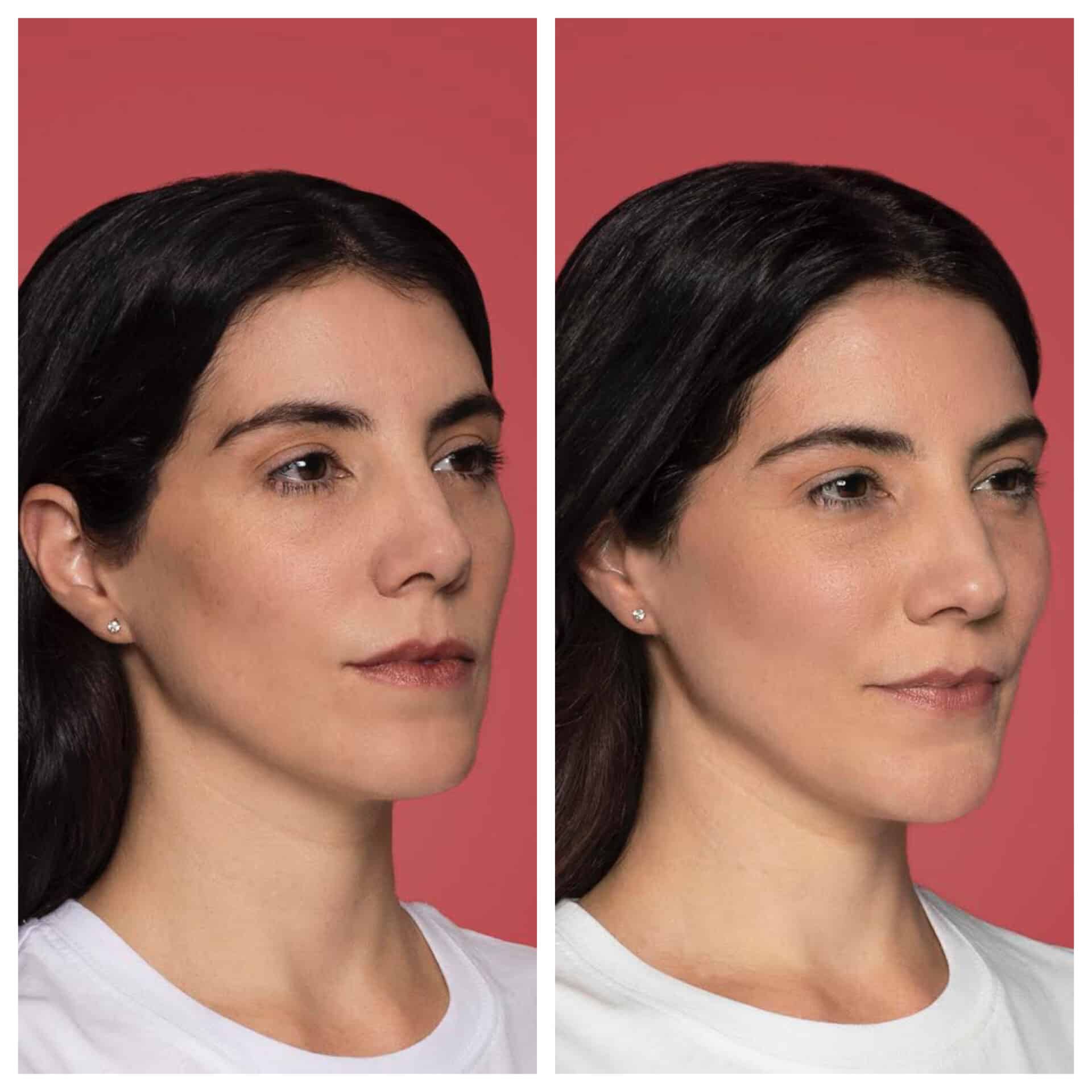 before and after treatment