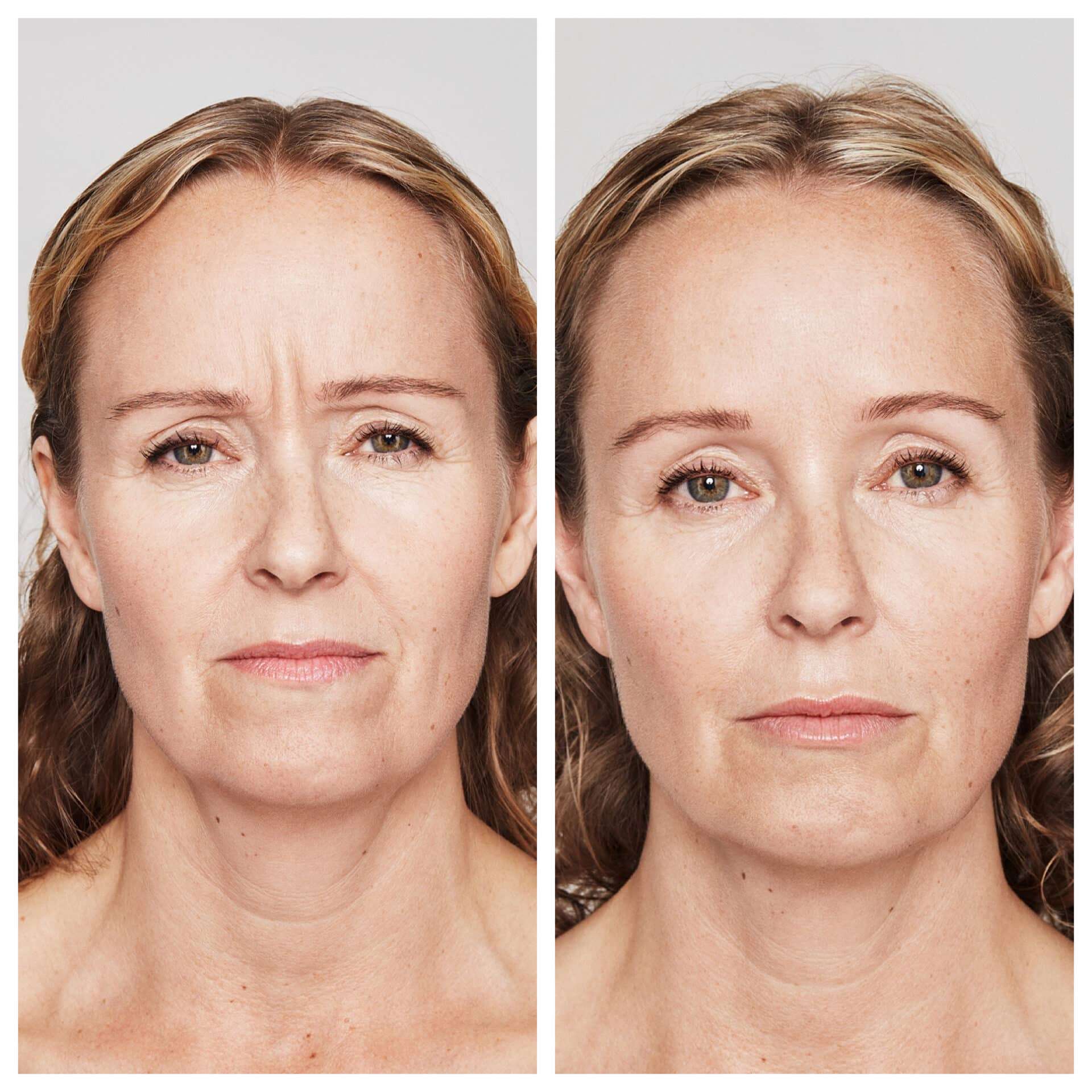 before and after treatment