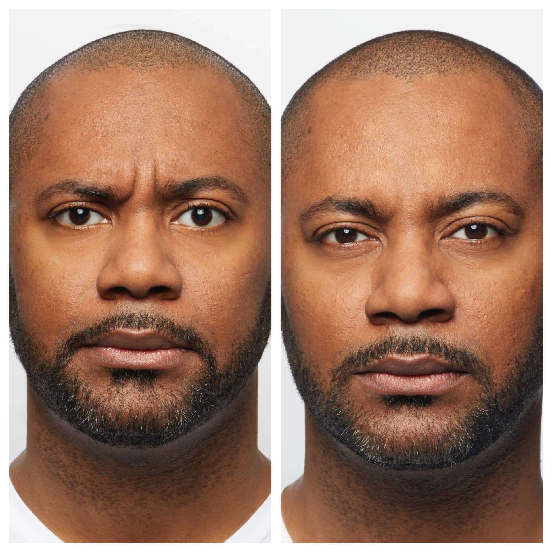 before and after treatment