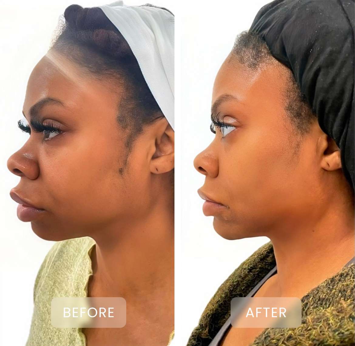 before and after treatment